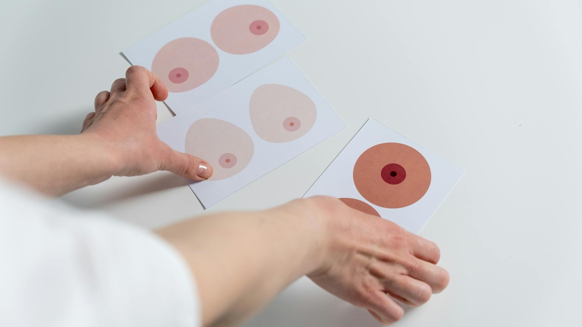 Οι καλοήθεις παθήσεις μαστού - Ινοαδένωμα